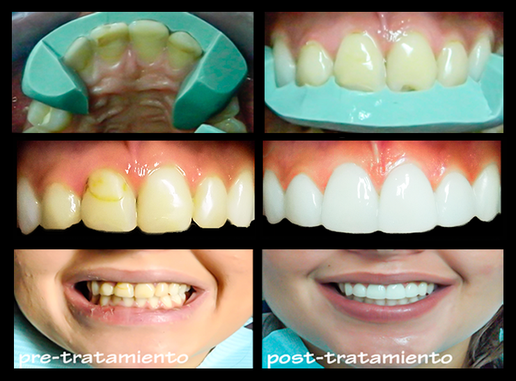 Casos&Procedimientos-Bef&Aft-04A